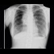 Mediastinal lymphoma, chest radiograph: X-ray - Plain radiograph