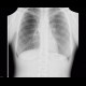 Mediastinal lymphoma, chest radiograph, follow-up: X-ray - Plain radiograph