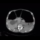 Megacolon: CT - Computed tomography