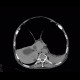 Megacolon: CT - Computed tomography