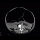 Megacolon: CT - Computed tomography