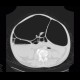 Megacolon: CT - Computed tomography