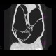 Megacolon: CT - Computed tomography