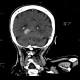 Menigioma of cerebellar tentorium: CT - Computed tomography