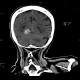 Menigioma of cerebellar tentorium: CT - Computed tomography