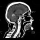 Menigioma of cerebellar tentorium: CT - Computed tomography