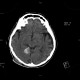 Menigioma of cerebellar tentorium: CT - Computed tomography