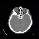 Menigioma en plaque: CT - Computed tomography