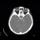 Menigioma en plaque, sphenoid bone: CT - Computed tomography