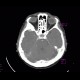 Menigioma en plaque, sphenoid bone: CT - Computed tomography