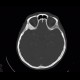 Menigioma en plaque, sphenoid bone: CT - Computed tomography