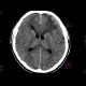 Meningioma of cribrous lamina: CT - Computed tomography
