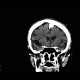 Meningioma of falx cerebri: CT - Computed tomography