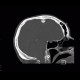 Meningioma of falx cerebri: CT - Computed tomography