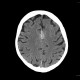 Meningioma of falx cerebri: CT - Computed tomography