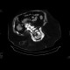 Spina bifida occulta, meningocoele, sacral: CT - Computed tomography