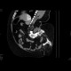Spina bifida occulta, meningocoele, sacral: CT - Computed tomography