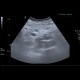 Lymphoma, mesenterial lymphadenopathy, edema of mesentery, correlation: US - Ultrasound