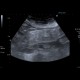 Mesenterial lipodystrophy on ultrasound: US - Ultrasound