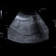 Mesenterial lipodystrophy on ultrasound: US - Ultrasound