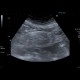 Mesenterial lipodystrophy on ultrasound: US - Ultrasound