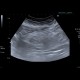 Mesenterial lipodystrophy on ultrasound: US - Ultrasound