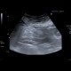 Mesenterial lipodystrophy on ultrasound: US - Ultrasound