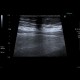 Mesenterial lipodystrophy on ultrasound: US - Ultrasound