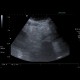 Mesenterial lipodystrophy on ultrasound: US - Ultrasound