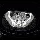 Mesenteric lipomatosis in steroid treatment: CT - Computed tomography