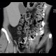 Mesenteric lipomatosis in steroid treatment: CT - Computed tomography