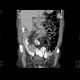 Mesenterium commune, gut malrotation: CT - Computed tomography