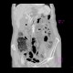 Mesenterial occlusion, gas in portal vein: CT - Computed tomography