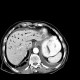 Mesenterial occlusion, gas in portal vein: CT - Computed tomography