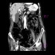 Mesenterial occlusion, gas in portal vein: CT - Computed tomography
