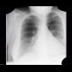 Lung congestion, first degree: X-ray - Plain radiograph