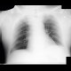 Lung congestion, first degree: X-ray - Plain radiograph