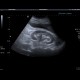 Renal obstruction: US - Ultrasound