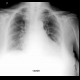 Lung congestion, mild: X-ray - Plain radiograph