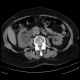 Hydronephrosis: CT - Computed tomography