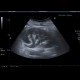 Hydronephrosis: US - Ultrasound