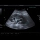 Hydronephrosis: US - Ultrasound