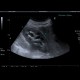 Hydronephrosis: US - Ultrasound