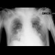 Lung congestion, supine chest radiograph: X-ray - Plain radiograph