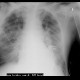 Lung congestion: X-ray - Plain radiograph