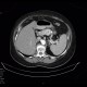 Metastasis of renal cell carcinoma in pancreas and adrenal gland, nephrectomy: CT - Computed tomography