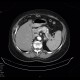 Metastasis of renal cell carcinoma in pancreas and adrenal gland, nephrectomy: CT - Computed tomography