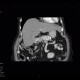 Metastasis of renal cell carcinoma in pancreas and adrenal gland, nephrectomy: CT - Computed tomography