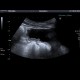 Liver metastasis, peritoneal carcinomatosis: US - Ultrasound
