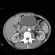 Small cell lung carcinoma, SCLC, metastasis in pancreas, after therapy: CT - Computed tomography